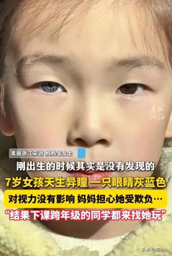 醫(yī)生回應(yīng)7歲女孩天生異瞳