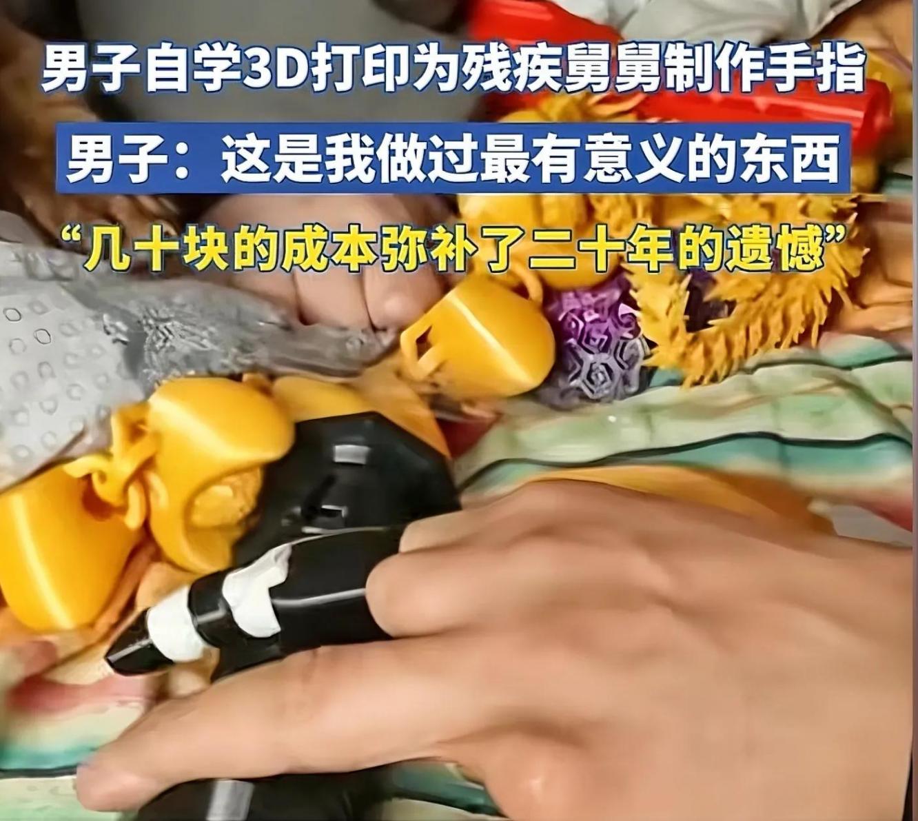 男子用3D打印幫舅舅補(bǔ)上斷指